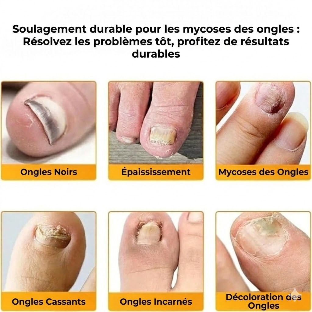 FungalPatch – Kit de Soin Intensif des Ongles – Patchs Antifongiques Auto-adhésifs