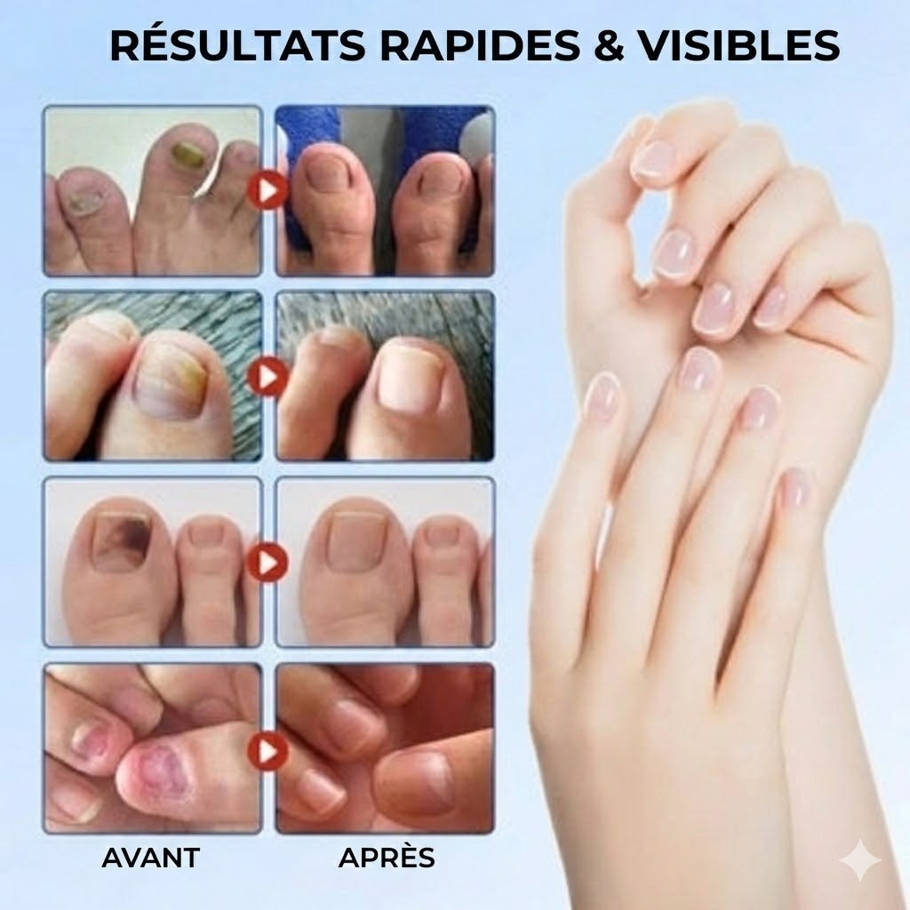 FungalPatch – Kit de Soin Intensif des Ongles – Patchs Antifongiques Auto-adhésifs